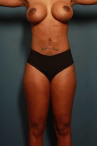 after liposuction female patient front view case 2315