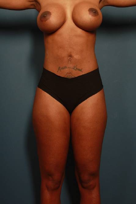 after liposuction female patient front view case 2315