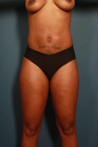 before liposuction female patient front view case 2315