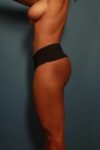 after liposuction female patient left side view case 2315