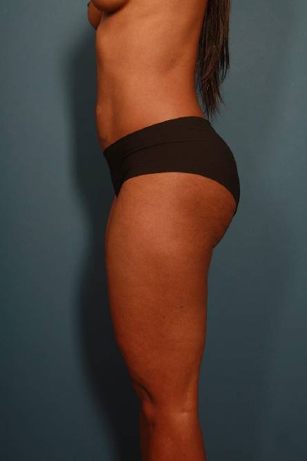 before liposuction female patient left side view case 2315