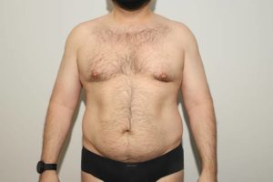 before liposuction male patient front view case 2322