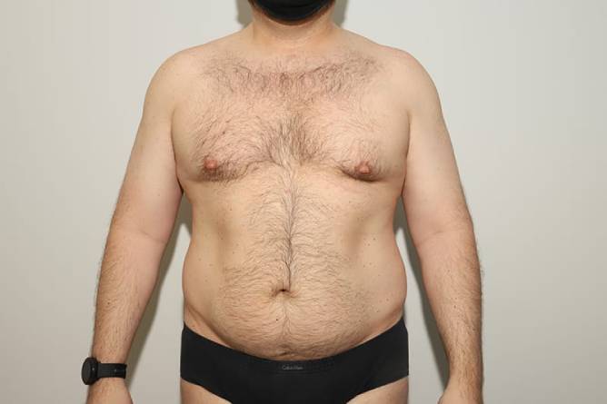 before liposuction male patient front view case 2322