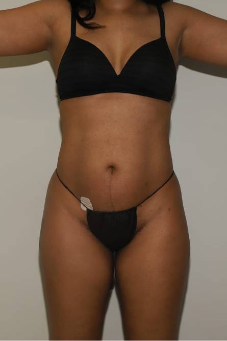 before liposuction female patient front view case 2325