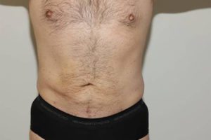 after liposuction male patient front view | Houston