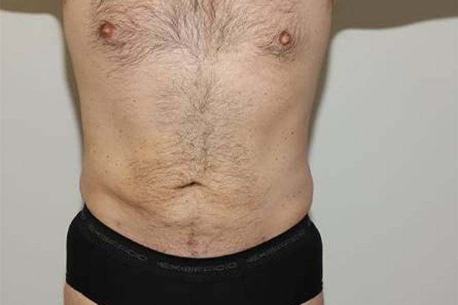 after liposuction male patient front view | Houston