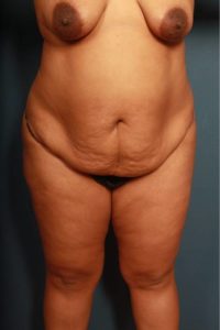 before panniculectomy female patient front view case 1596