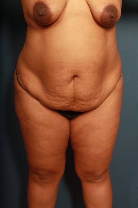 before panniculectomy female patient front view case 1596