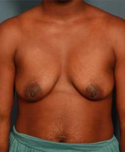 before periareolar breast lift front view female patient case 1302