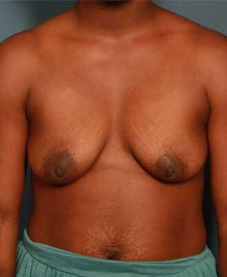 before periareolar breast lift front view female patient case 1302
