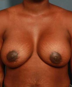 after periareolar breast lift front view female patient case 1302