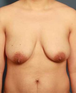 before periareolar breast lift front view female patient case 1305