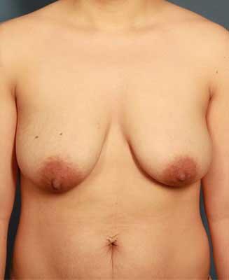 before periareolar breast lift front view female patient case 1305