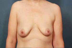 before periareolar breast lift front view female patient case 1308