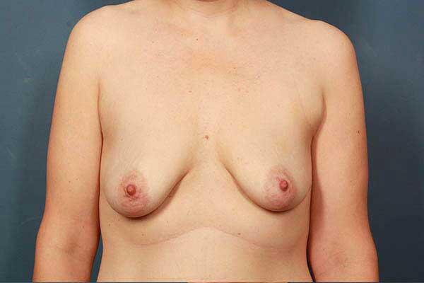 before periareolar breast lift front view female patient case 1308