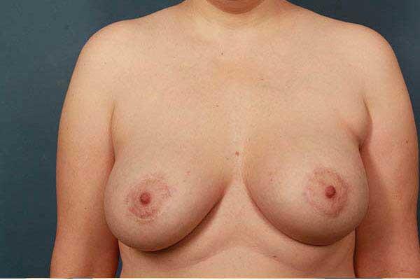 after periareolar breast lift front view female patient case 1308