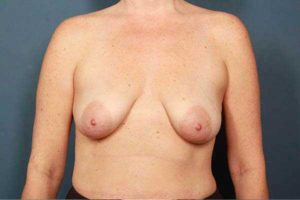 before periareolar breast lift front view female patient case 1313
