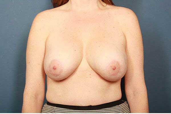 after periareolar breast lift front view female patient case 1313