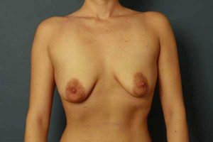 before periareolar breast lift front view female patient case 1322