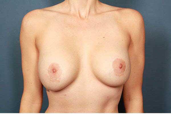 after periareolar breast lift front view female patient case 1322