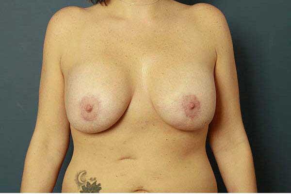 after periareolar breast lift front view female patient case 1333