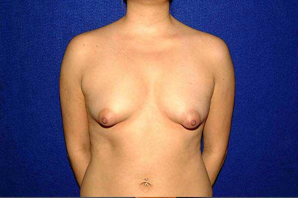 before periareolar breast lift front view female patient case 1336