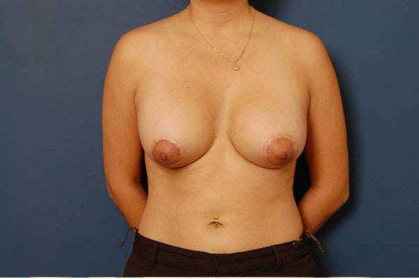 after periareolar breast lift front view female patient case 1336