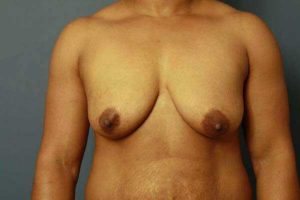 before periareolar breast lift front view female patient case 1448