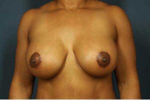after periareolar breast lift front view female patient case 1448