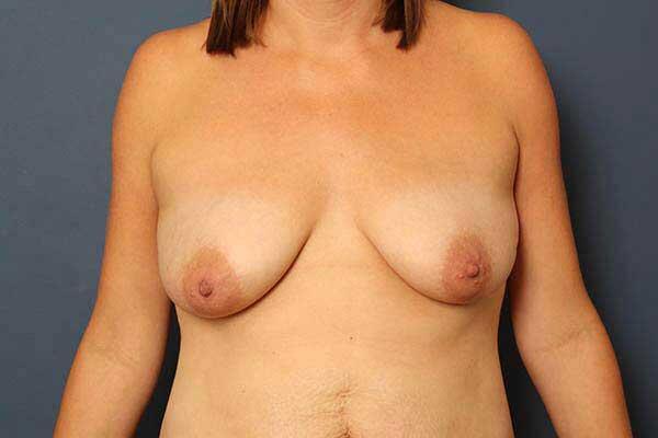 before periareolar breast lift front view female patient case 1458