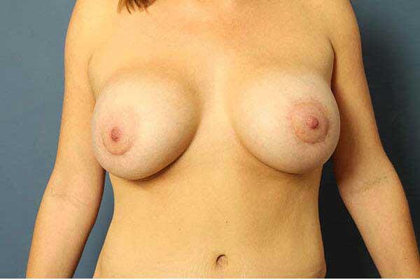after periareolar breast lift front view female patient case 1458