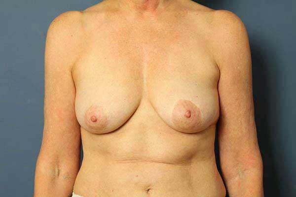 before periareolar breast lift front view female patient case 1462