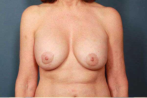 after periareolar breast lift front view female patient case 1462