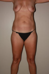 before tummy tuck female patient front view case 2158