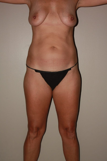 before tummy tuck female patient front view case 2158