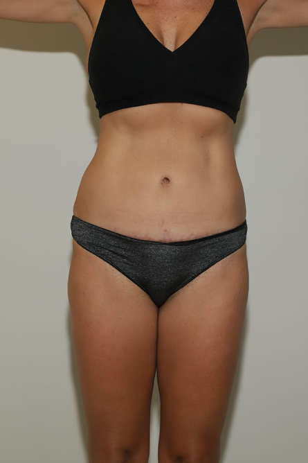 after tummy tuck female patient front view case 2158