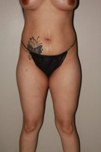 before tummy tuck female patient front view case 2161