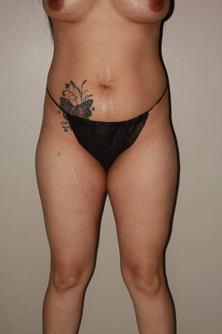 before tummy tuck female patient front view case 2161