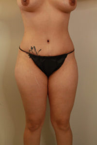 after tummy tuck female patient front view case 2161