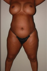 before tummy tuck female patient front view case 2167