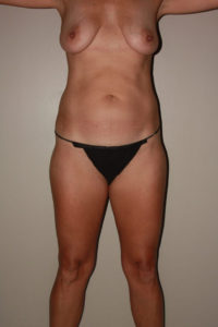 before tummy tuck female patient front view case 2170