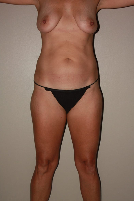 before tummy tuck female patient front view case 2170