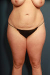 before tummy tuck female patient front view case 2176