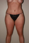 after tummy tuck female patient front view case 2176