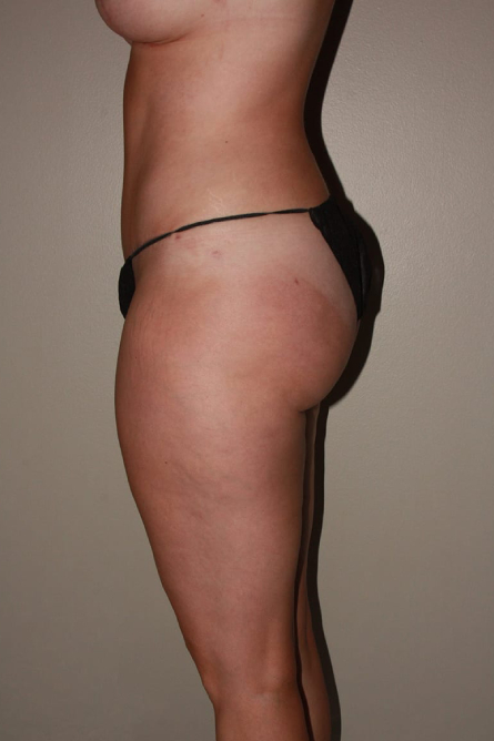 after tummy tuck female patient left side view case 2176