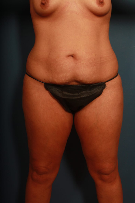 before tummy tuck female patient front view case 2181
