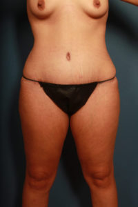 after tummy tuck female patient front view case 2181