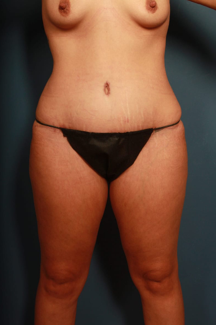 after tummy tuck female patient front view case 2181