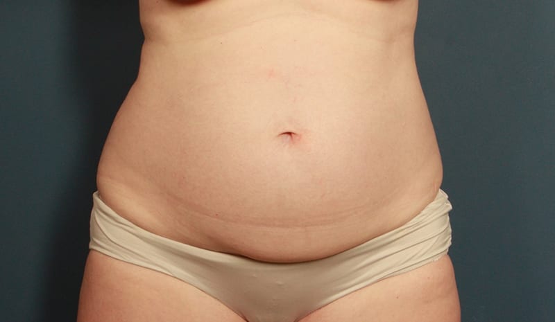 before tummy tuck female patient front view case 2184