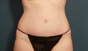 after tummy tuck female patient front view case 2184
